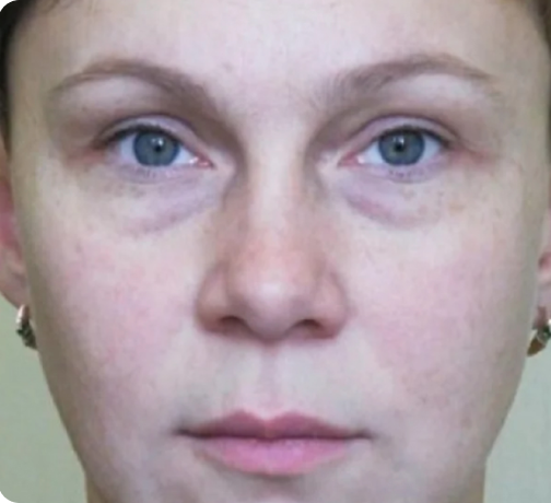 Удаление родинок - до