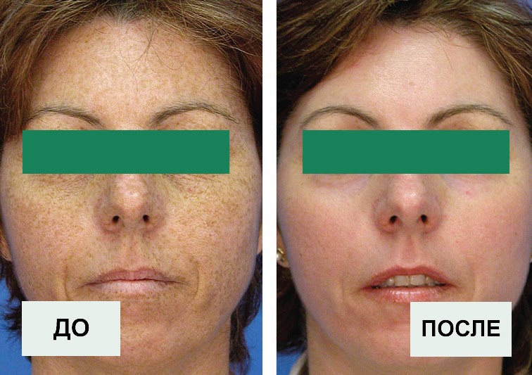 Удаление пигментации с помощью лазера