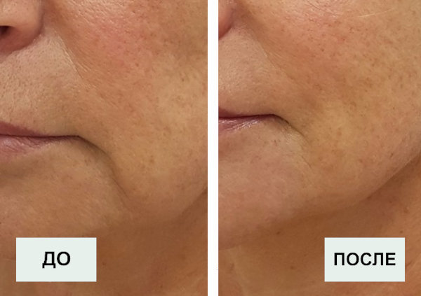 Процедура лазерного омоложения