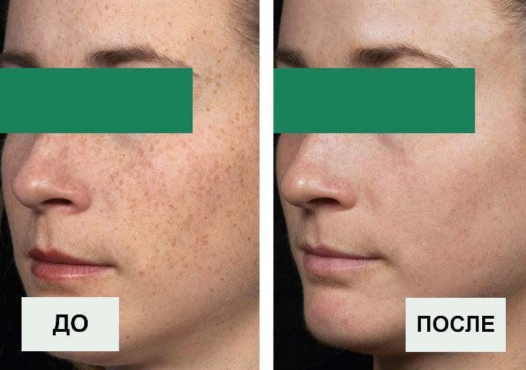 Коррекция гиперпигментации лица лазером