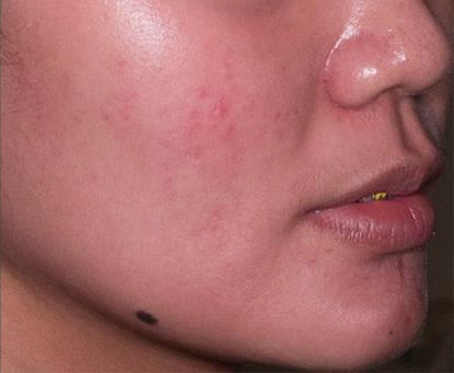 Удаление сосудов лазером