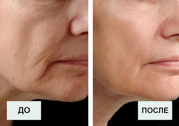 Процедура лазерного омоложения
