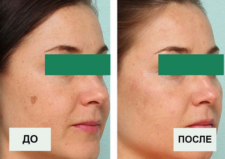 Лазерное удаление пигментных пятен на лице