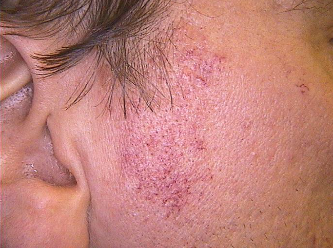 Удаление сосудов лазером