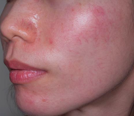 Удаление сосудов лазером