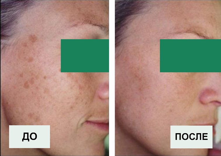 Удаление пигментных пятен и коррекция цвета лица