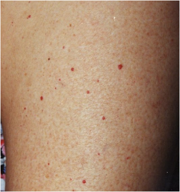 Удаление сосудов лазером