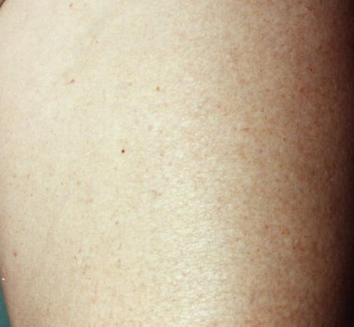 Удаление сосудов лазером