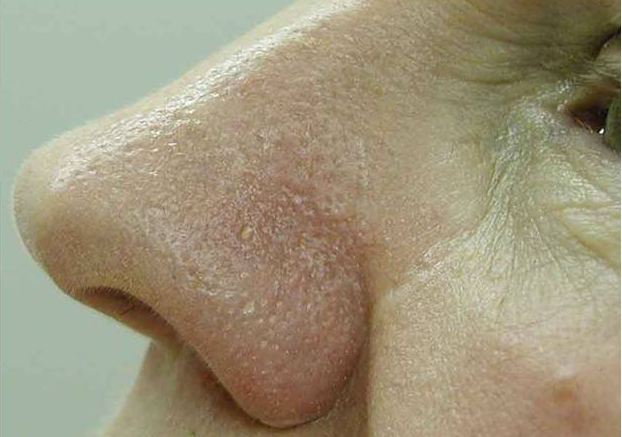 Удаление сосудов лазером