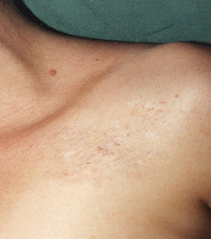 Удаление сосудов лазером