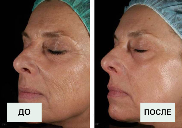 Процедура лазерного омоложения