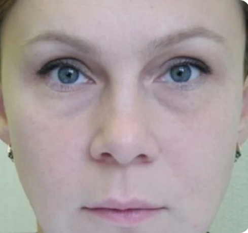 Лазерная эпиляция - после