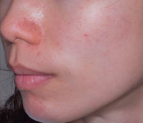 Удаление сосудов лазером