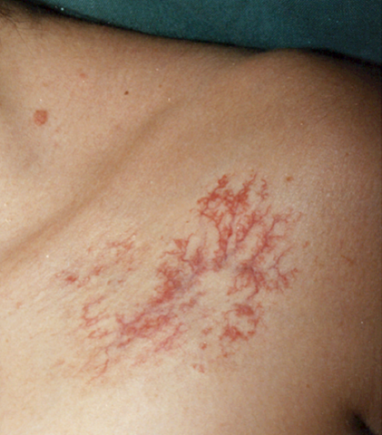 Удаление сосудов лазером