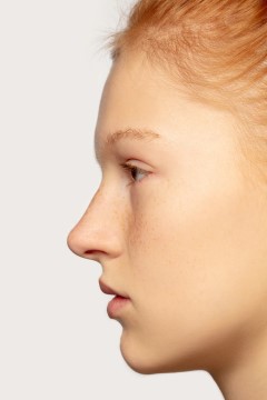 Коррекция углов нижней челюсти