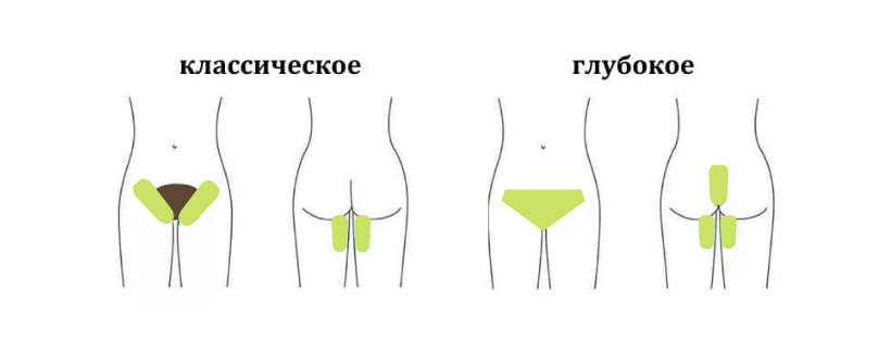 эпиляция глубокого бикини