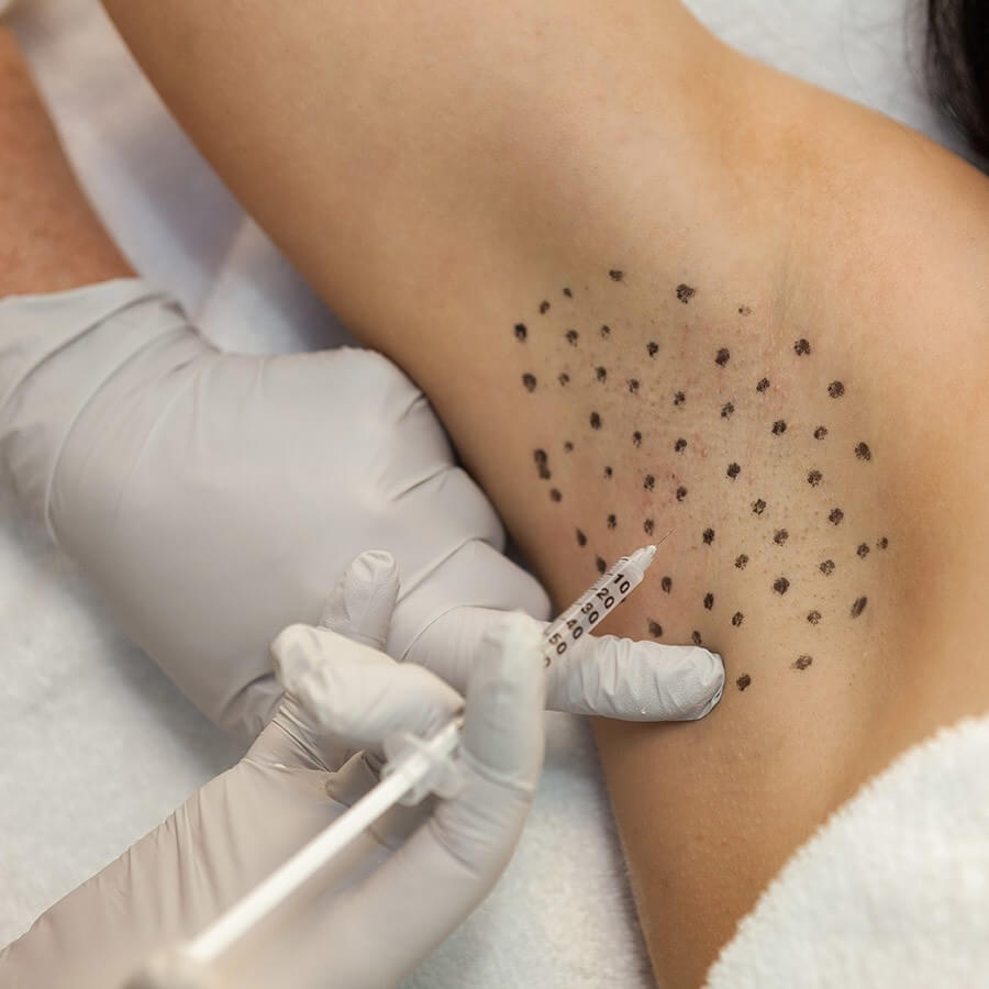 Лечение гипергидроза