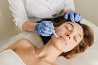 Нитевой лифтинг лица